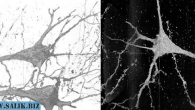 Photo of В мозгу людей с шизофренией заметили необычные нейроны