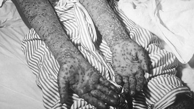 Photo of Как СССР справился с эпидемией черной оспы за 19 дней